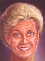 chemical peel 3