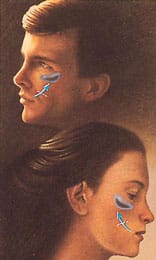 facial implant 3 facial implant 1 1