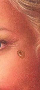skin cancer 1 skin cancer 1