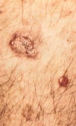skin cancer 2 skin cancer 2