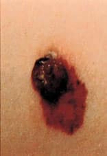 skin cancer 3 skin cancer 3