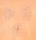 spider veins 1