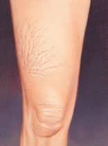 spider veins 2