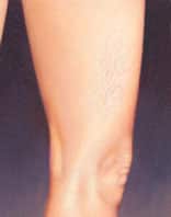 spider veins 5