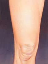spider veins 6