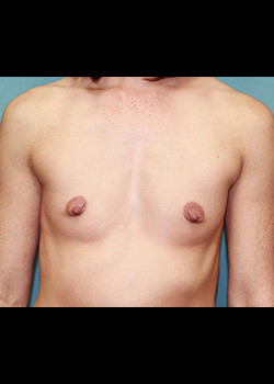 Before Image: Patient Case #3534 - front