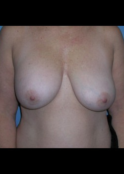 Before Image: Patient Case #231 - front