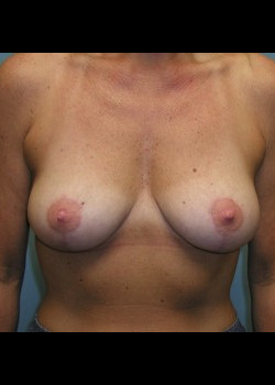 After Image: Patient Case #253 - front