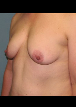 Before Image: Patient Case #2996 - front