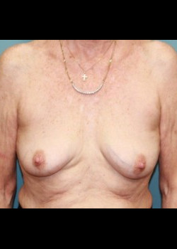 Before Image: Patient Case #4017 - front