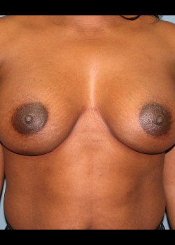 After Image: Patient Case #2654 - front