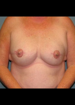After Image: Patient Case #2280 - front
