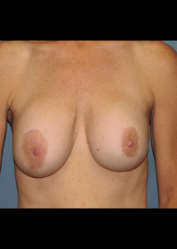 Before Image: Patient Case #200 - front