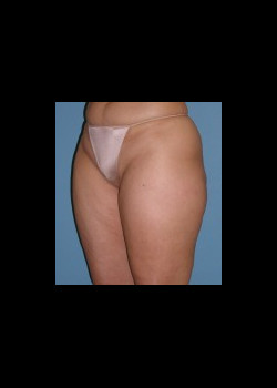 Before Image: Patient Case #2525 - front