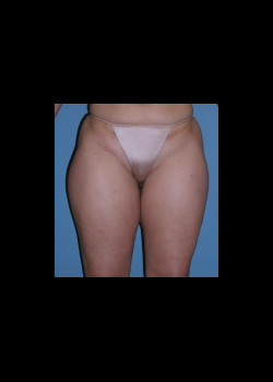 Before Image: Patient Case #2525 - front