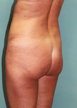 Before Image: Patient Case #3438 - front