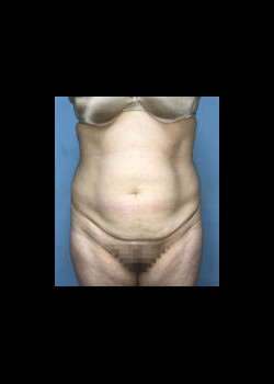 Before Image: Patient Case #4493 - front
