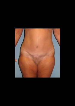 After Image: Patient Case #162 - front