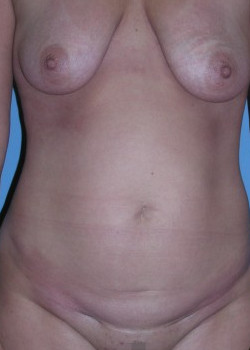 Before Image: Patient Case #3078 - front