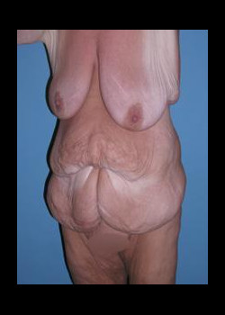 Before Image: Patient Case #19 - front