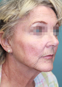 Before Image: Patient Case #4583 - other