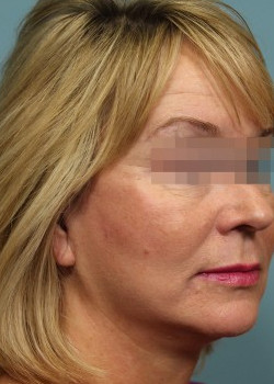 After Image: Patient Case #2426 - other