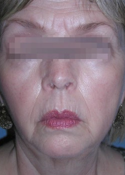 Before Image: Patient Case #2492 - front