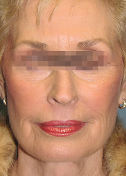 After Image: Patient Case #2864 - front