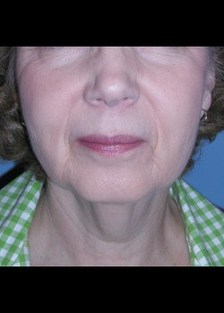 Before Image: Patient Case #2451 - front