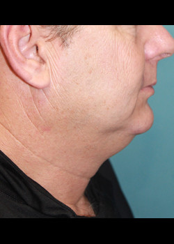 Before Image: Patient Case #3824 - front