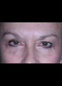 Before Image: Patient Case #247 - front