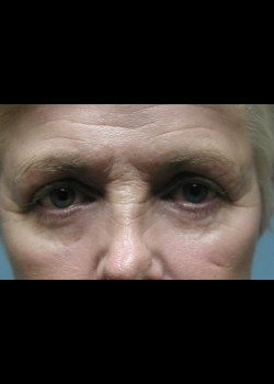 Before Image: Patient Case #257 - front