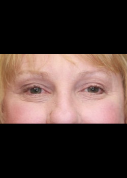 After Image: Patient Case #264 - front