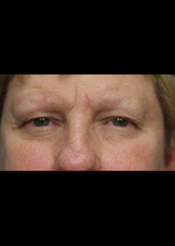 Before Image: Patient Case #264 - front