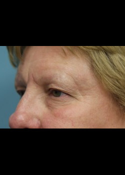 Before Image: Patient Case #264 - front