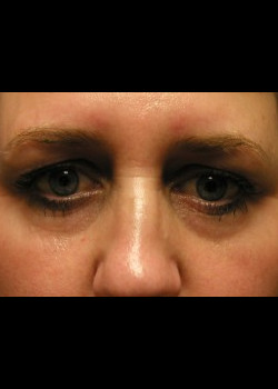 Before Image: Patient Case #272 - front