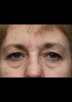 Before Image: Patient Case #285 - front