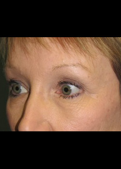 After Image: Patient Case #303 - front