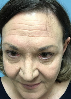 After Image: Patient Case #4484 - front