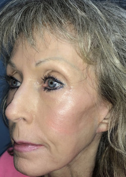After Image: Croton Oil Peel #4596 - other