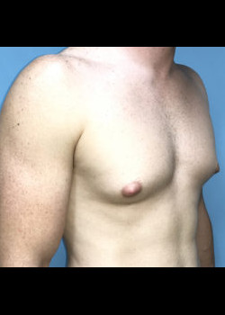 Male Breast Reduction #4462