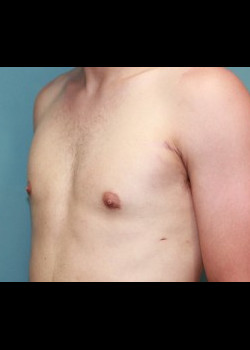 Male Breast Reduction #4078
