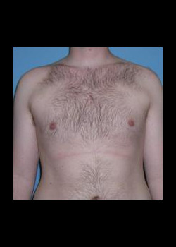 Male Breast Reduction #94