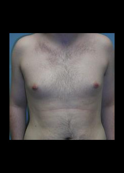 Male Breast Reduction #94