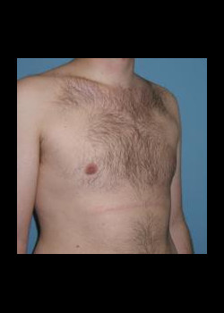 After Image: Male Breast Reduction #94 - other