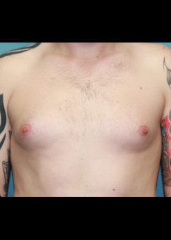Male Breast Reduction #3555