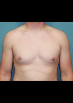 Male Breast Reduction #3609