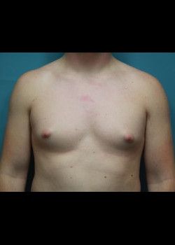 Male Breast Reduction #3609