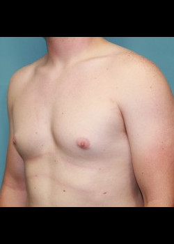 Male Breast Reduction #3609