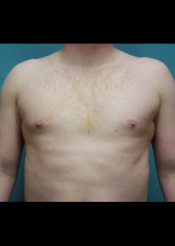 Male Breast Reduction#4029